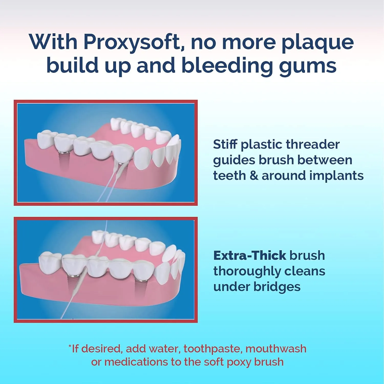 Proxysoft Dental Floss for Bridges and Implants 6 Packs - Floss Threaders for Bridges, Dental Implants, Braces with Extra-Thick Proxy Brush for Optimal Oral Hygiene -Teeth Bridge and Implant Cleaners